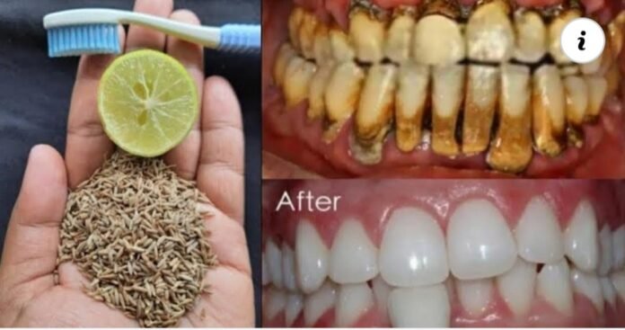 DIENTES BLANCOS Y BRILLANTES COMO PERLAS BLANQUEADORAS AL INSTANTE